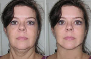 Necklift Female Patient Before and After