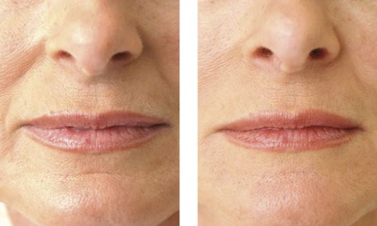 Lip Wrinkles Reveal Your Age & Much More-Here Is How To Fix Them