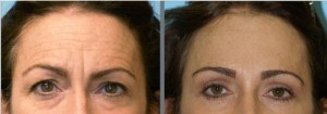 Forehead Wrinkles Before and After Procedure