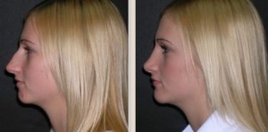 Tampa Rhinoplasty