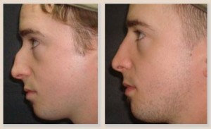 Rhinoplasty Patient Before and After Male Right View