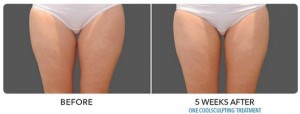 Thinner Thighs Patient Before and After