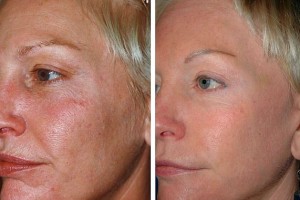 Laser Skin Resurfacing Patient Before and After Blonde Front Left