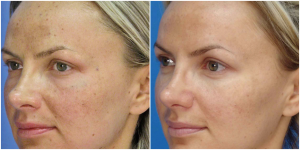 MicroLaserPeel 5 Microlaserpeel Female Patient Front Left Before and After