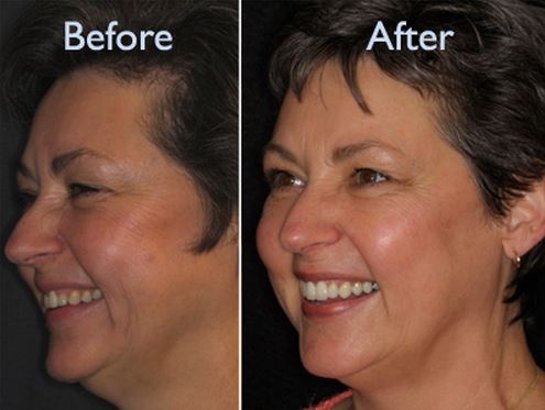 facelift
