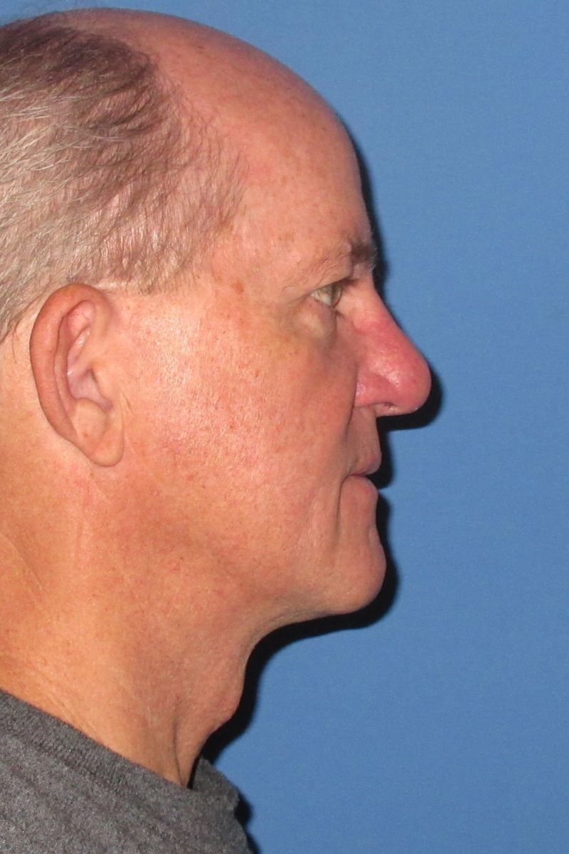 64 year-old Male Necklift After Right