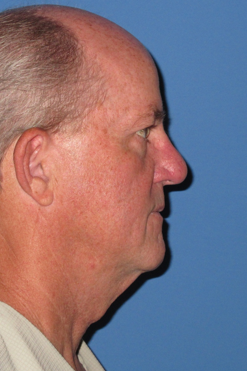 64 year-old Male Necklift Before Right