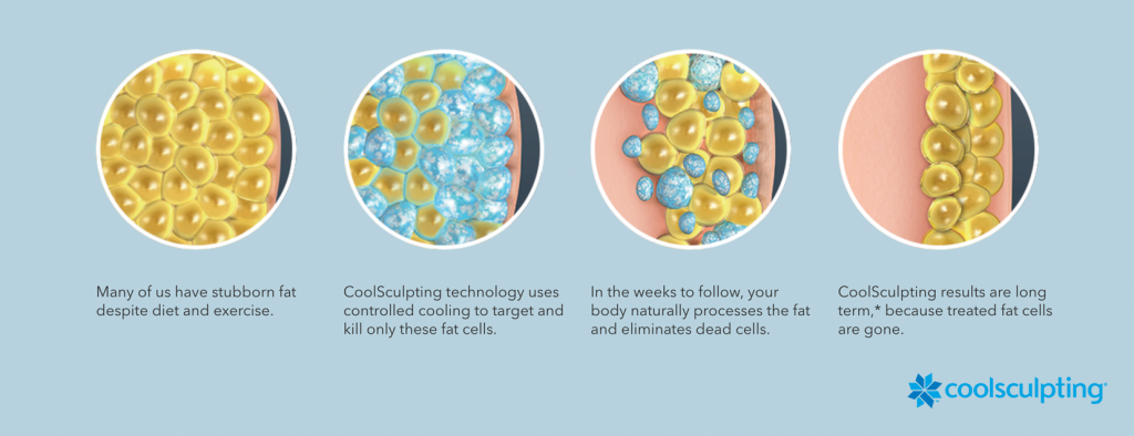 infographic of the coolsculpting process