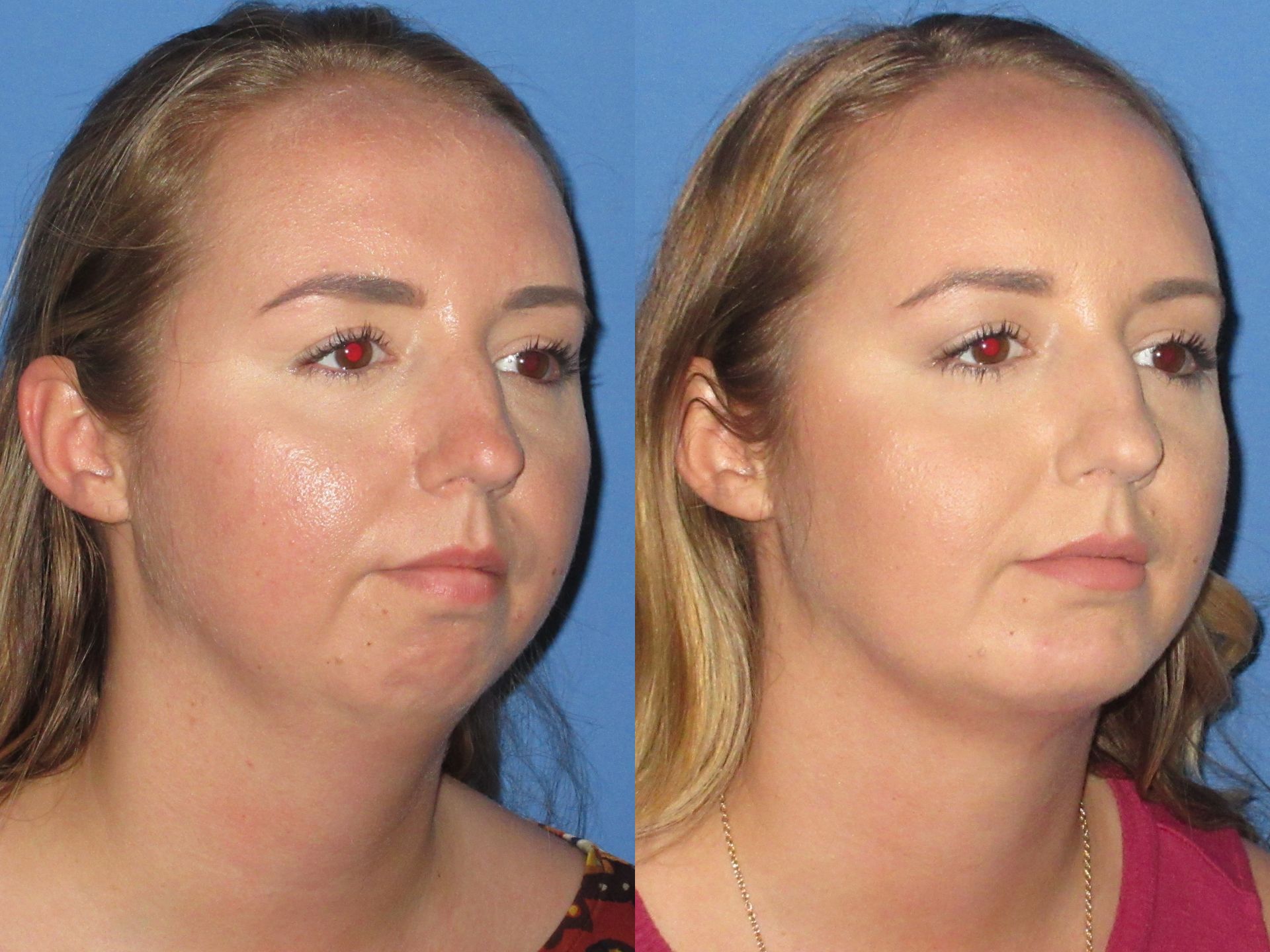 Chin & Cheek Implants 1 Chin Augmentation Before and After