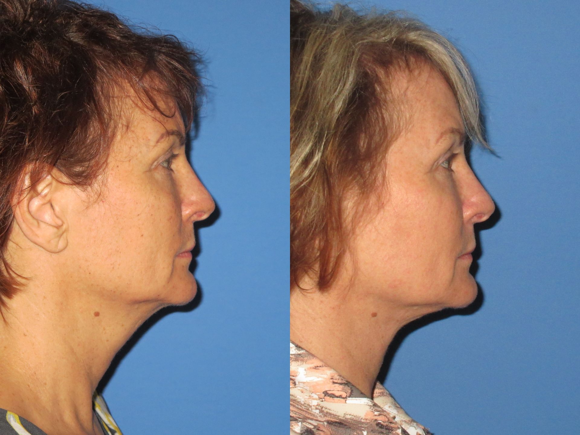 Neck Liposuction Before and After