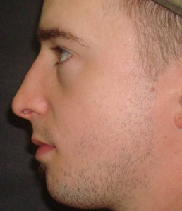 Dorsal Hump Removal 2 Male Rhinoplasty After
