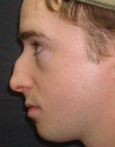 Dorsal Hump Removal 1 Male Rhinoplasty Before