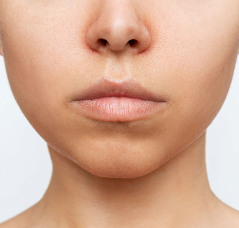 Face and Neck Liposuction