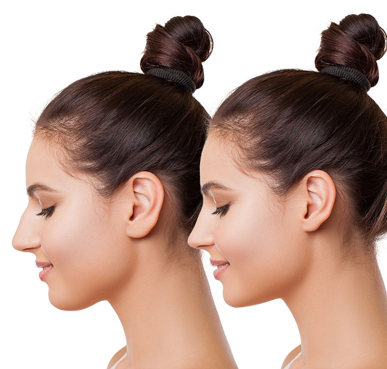 before and after rhinoplasty in Tampa