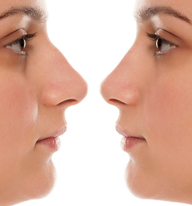 Rhinoplasty in Riverview, FL