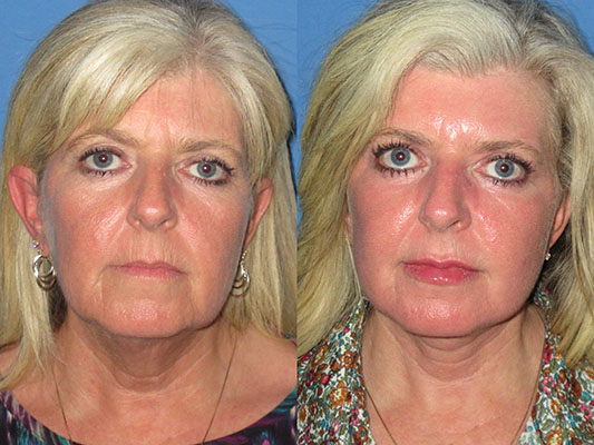 facelift with laser before and after