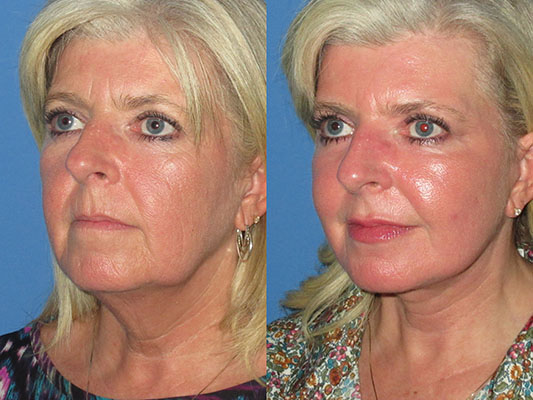 facelift with laser before and after