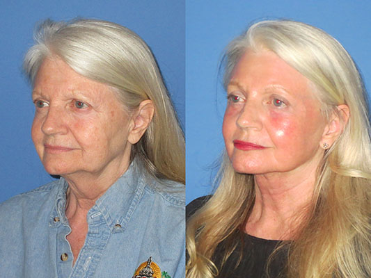 Facelift with laser Before and After