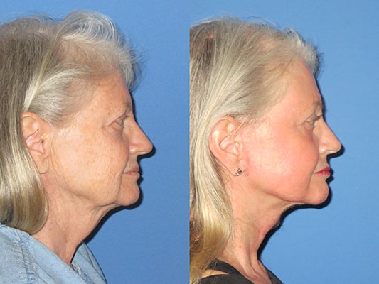 Facelift with Laser Before and After