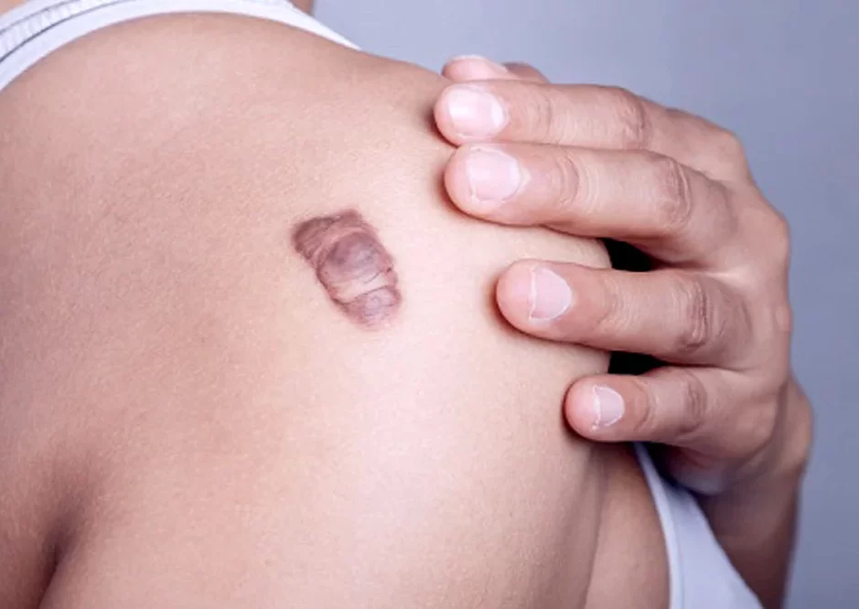 Keloid Removal Tampa