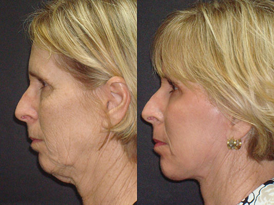 Sharon facelift and laser Before and After