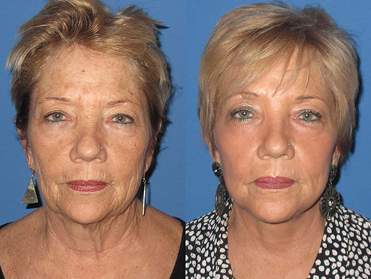 Facelift Before and After