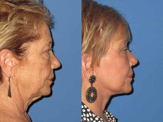 facelift Before and After