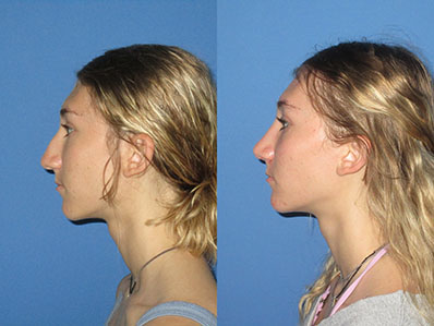 Before After Images nose job