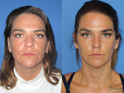 Before After Images rhinoplasty