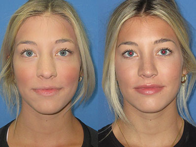 Before After Images rhinoplasty