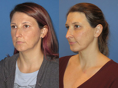 Before After Images rhinoplasty