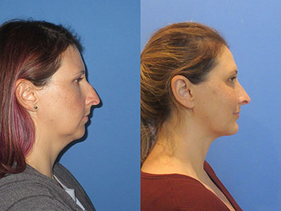 Before After Images chin and necklift