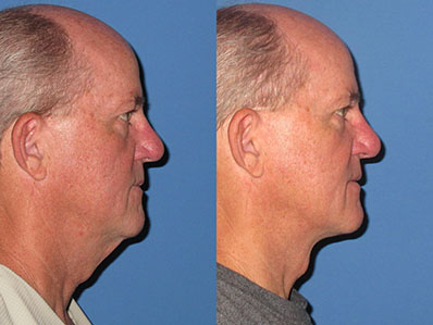Before After Images neck lift