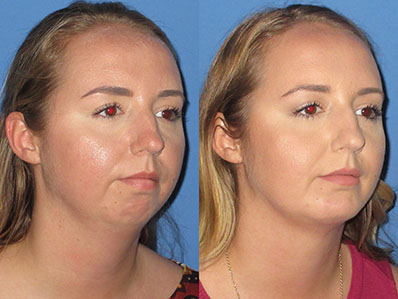 Before After Images chin lipo