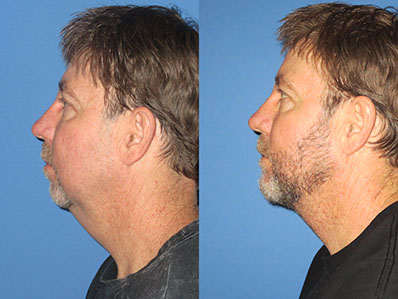 Before After Images