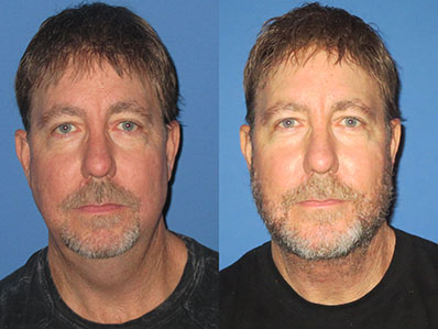 Before After Images