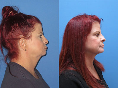 Before After Images chin and neck lift