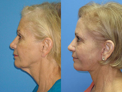 Before After Images