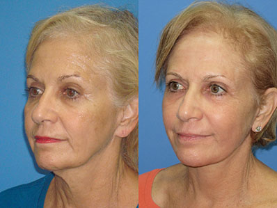 Before After Images