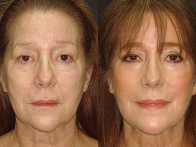 Before After Images