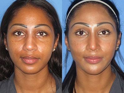 Before After Images rhinoplasty