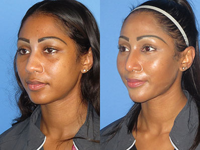 Before After Images rhinoplasty