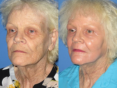 Before After Images fat transfer