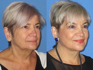 Before After Images