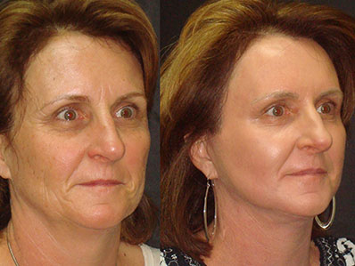 facelift necklift before and after