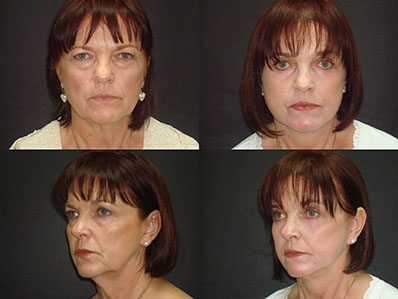 facelift and neck lift before and after