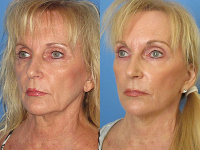 facelift before and after