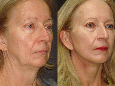 Facelift and Neck Lift Before and After