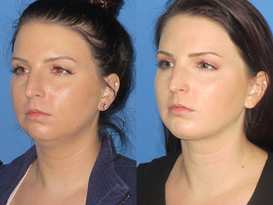 Before After Images nose job