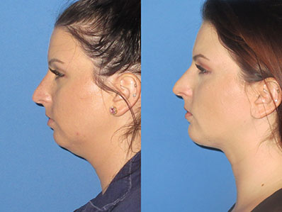 Before After Images chin augmentation